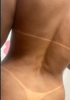 Resultado Bronzeamento GDA